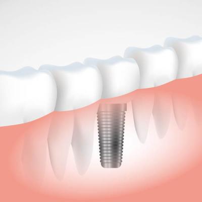 Implant dentaire Cannes Cannes Implant dentaire